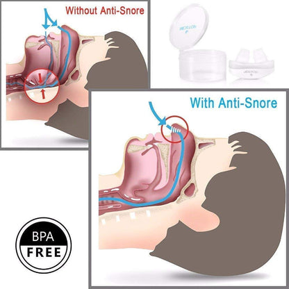 Anti-snoring device M21